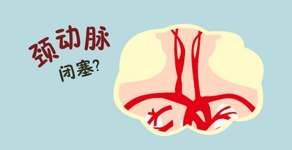頸動(dòng)脈完全閉塞還有救嗎？69歲老人用親身經(jīng)歷回答