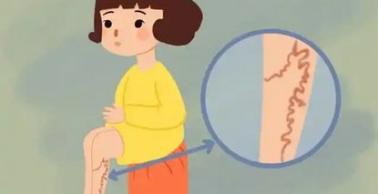 夏季告別蚯蚓腿全攻略